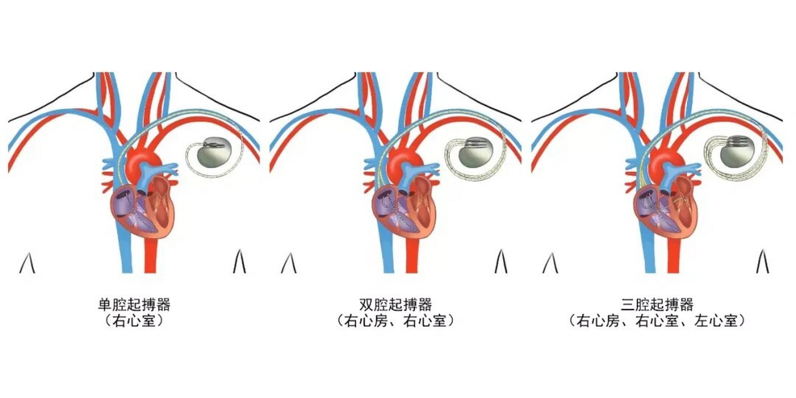 心脏起搏器的副作用图片