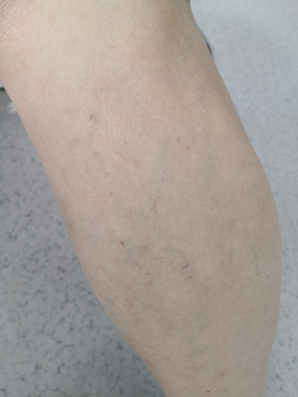 下肢静脉曲张##皮炎