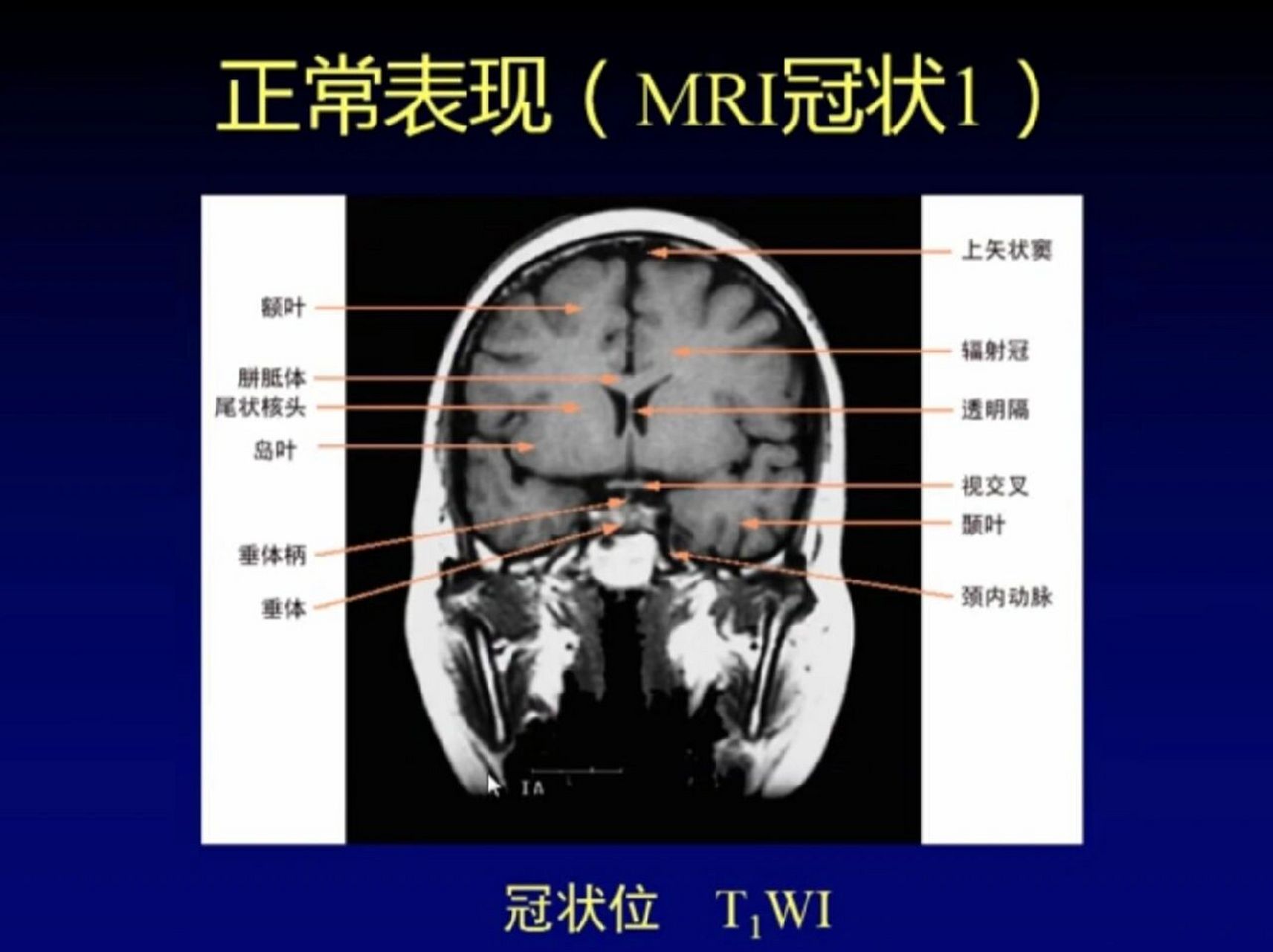 正常的脑核磁共振图片图片