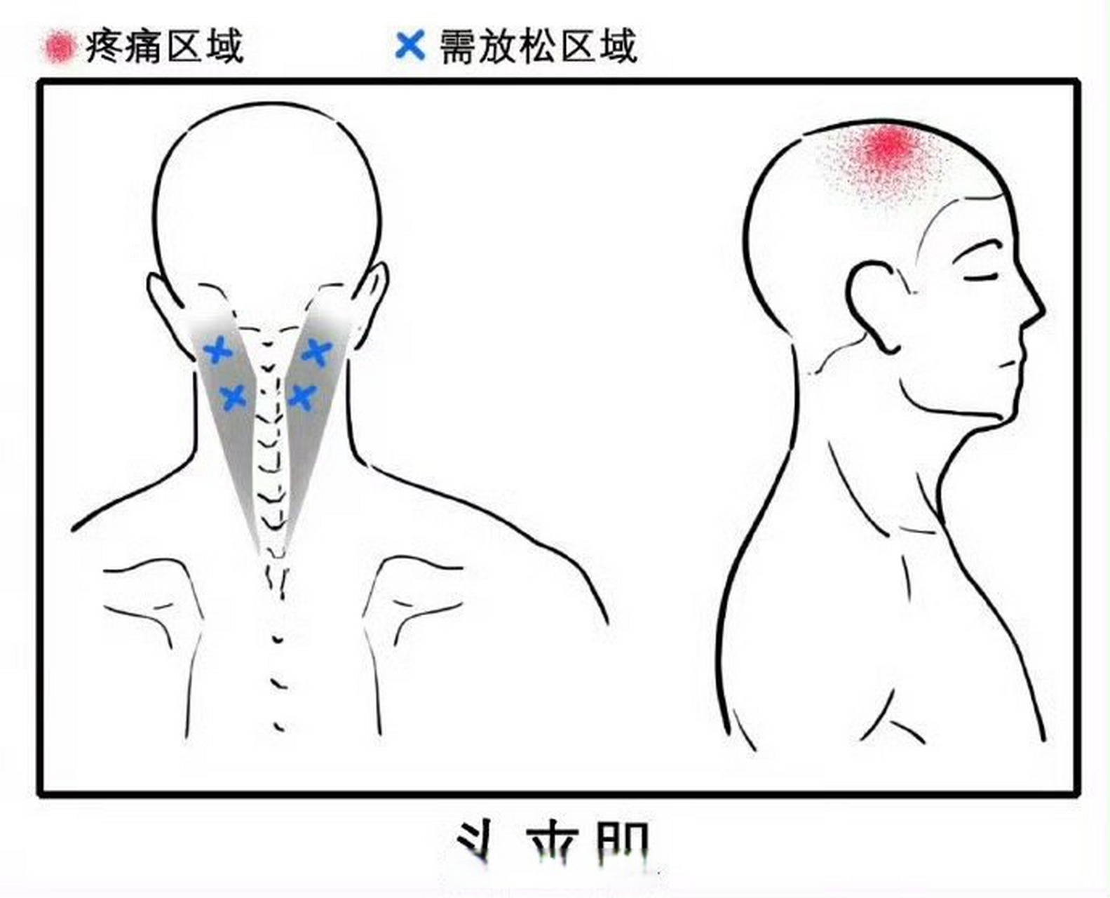 头疼按摩哪里最有效图片