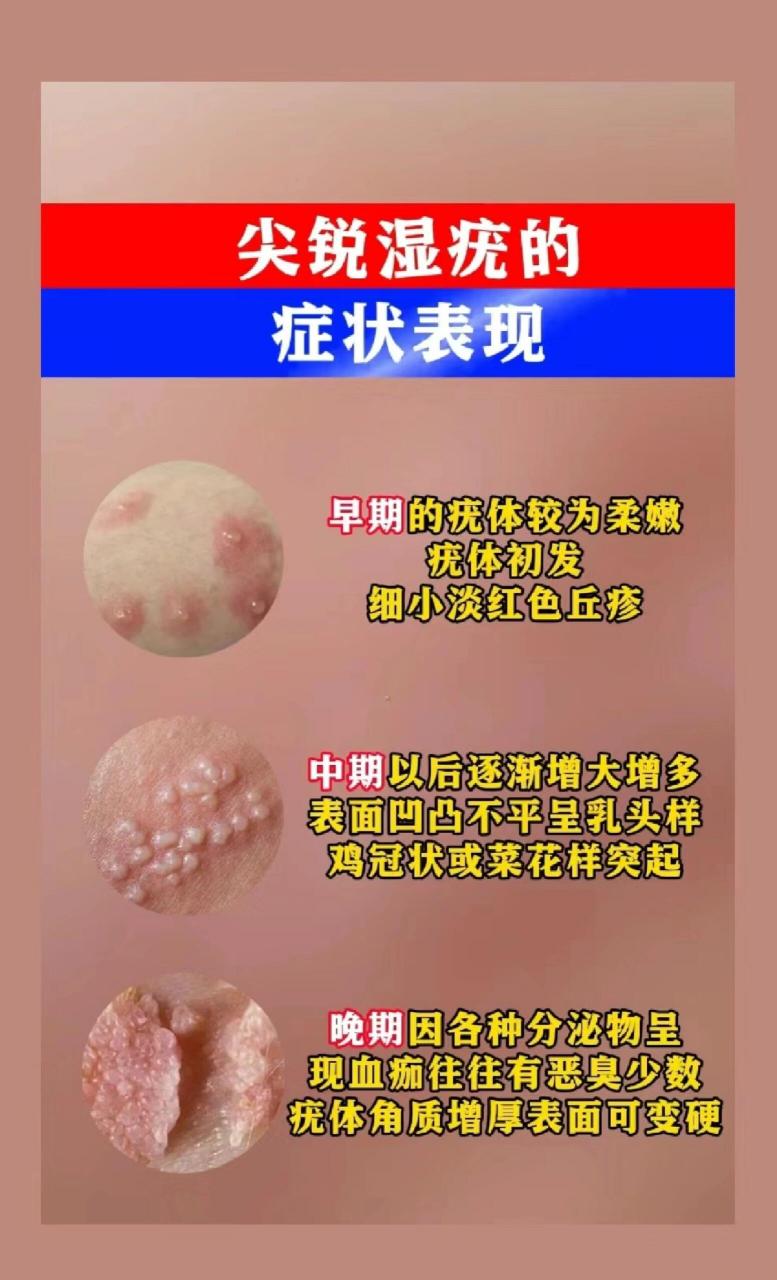 hpv感染尖锐湿疣症状表现 真假尖锐湿疣怎么分辨6315其实他们的
