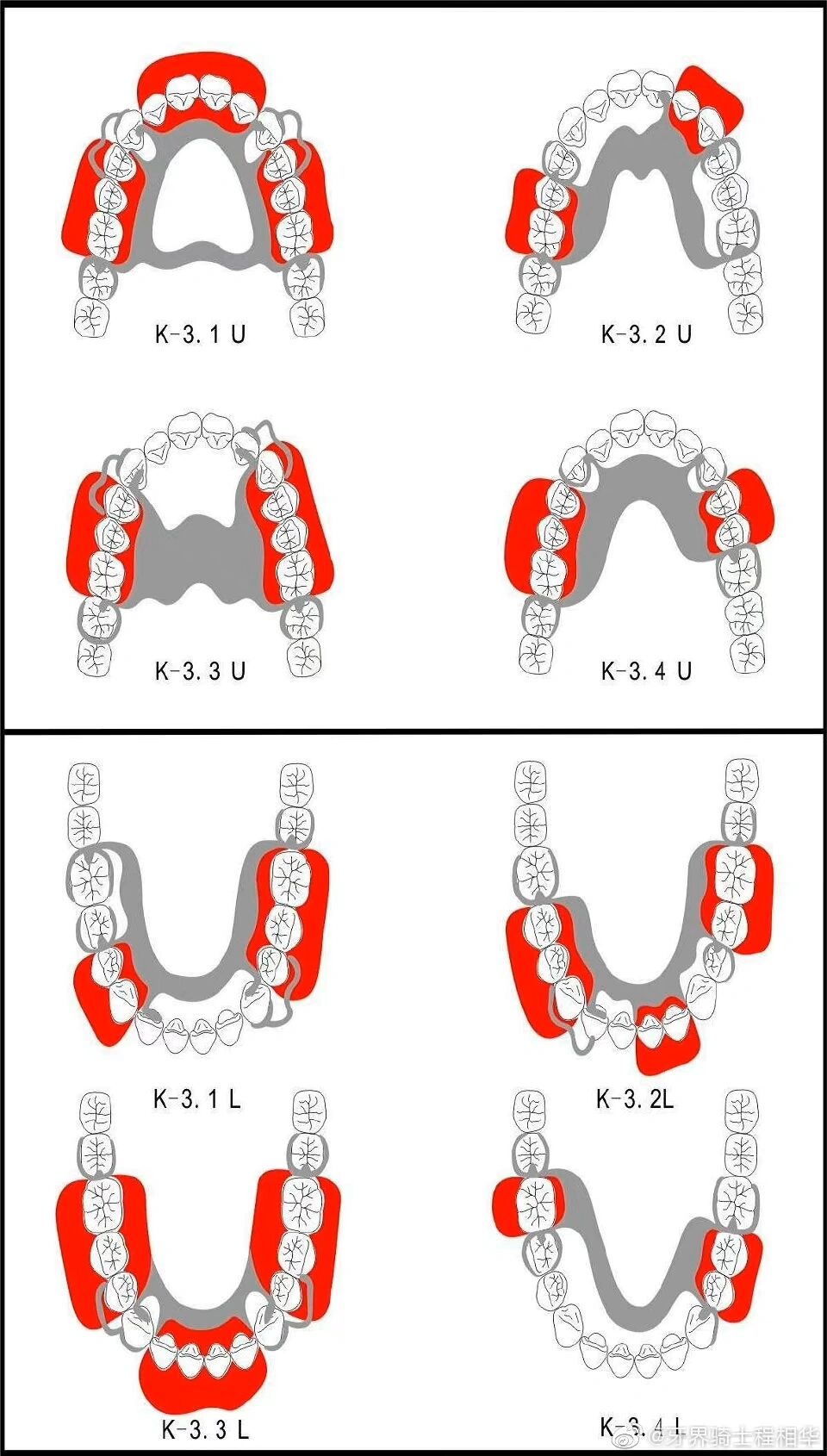 活动义齿修复设计