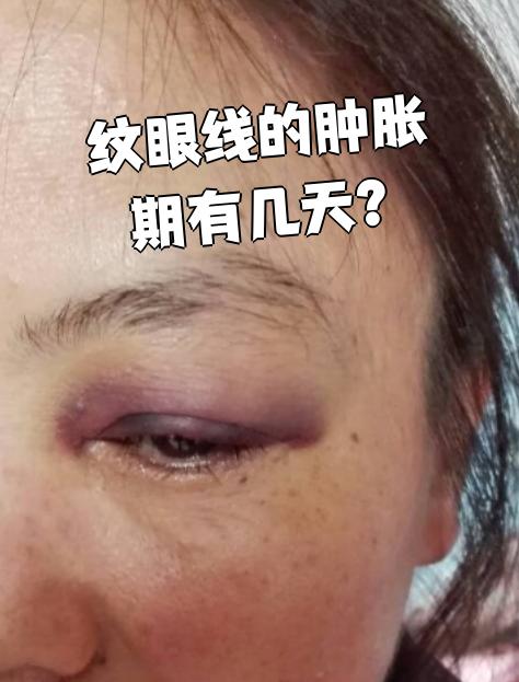 纹眼线后肿胀一般会持续3