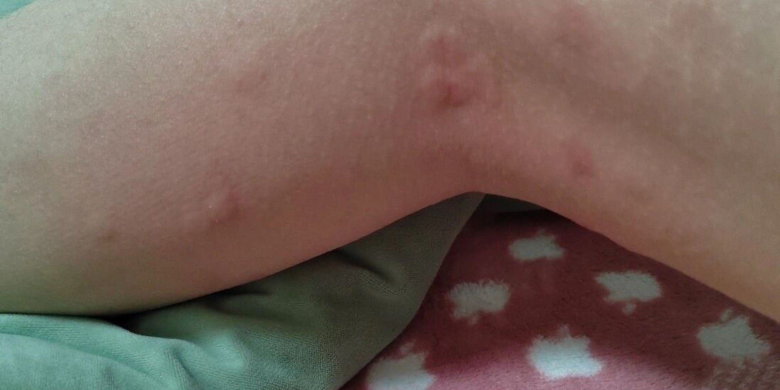 一觉睡醒发现自己腿上有很多红疙瘩,很痒