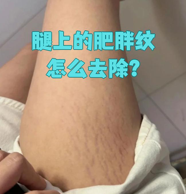 腿上的肥胖纹也叫萎缩纹或膨胀纹,主要是短期内体重增长过快,激素