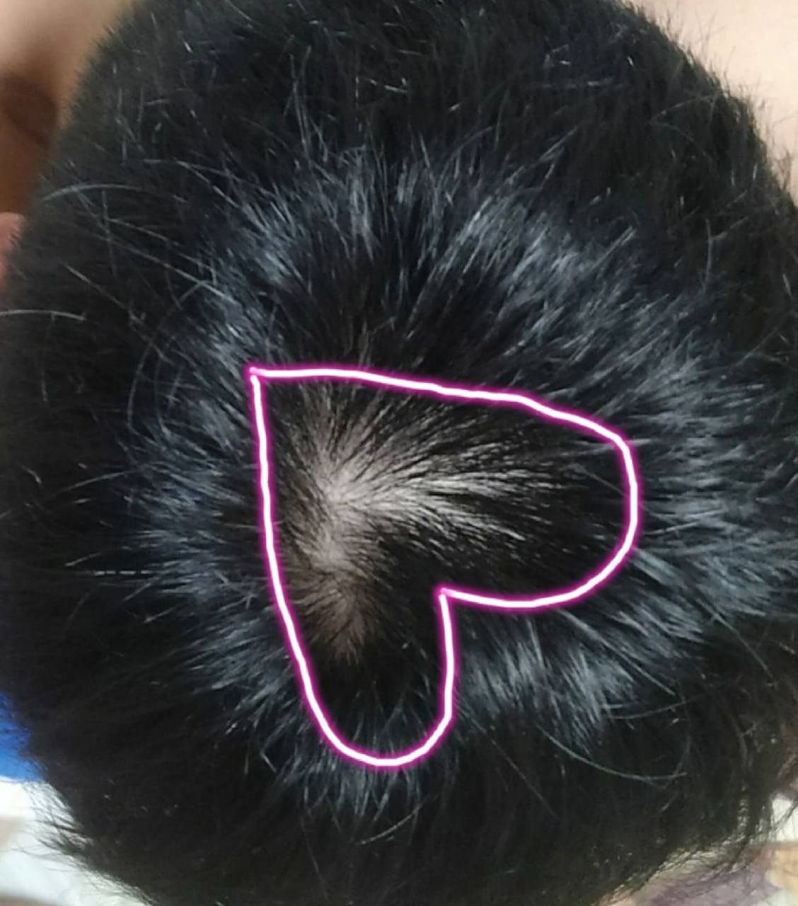 头顶发旋越来越秃该怎么办 现在发旋附近的头发感觉