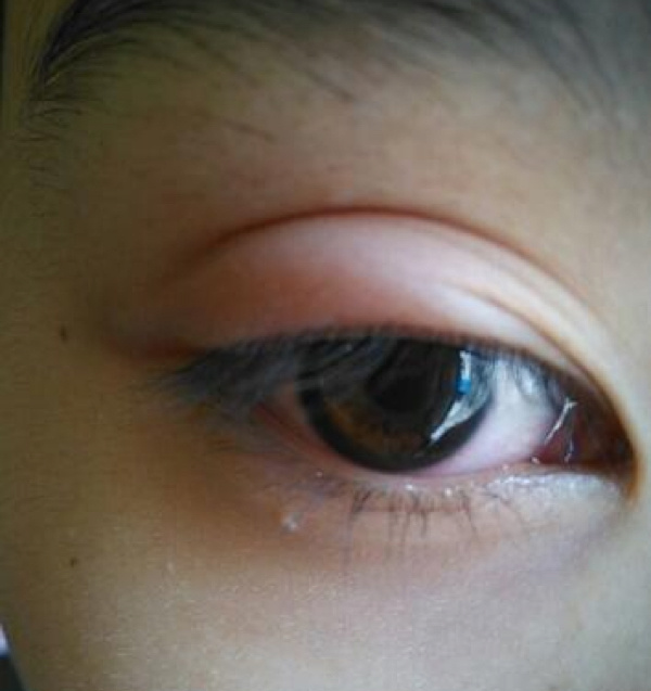 红肿发炎又痒又痛 去医院以后医生说是溃烂性眼睑缘炎 哭 我想了想就