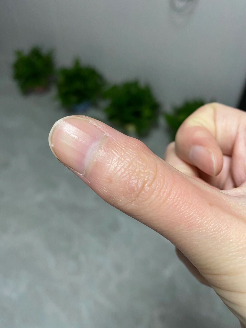 大拇指关节突出,有些疼 不知道怎么回事,感觉大拇指关节变的突出,还有