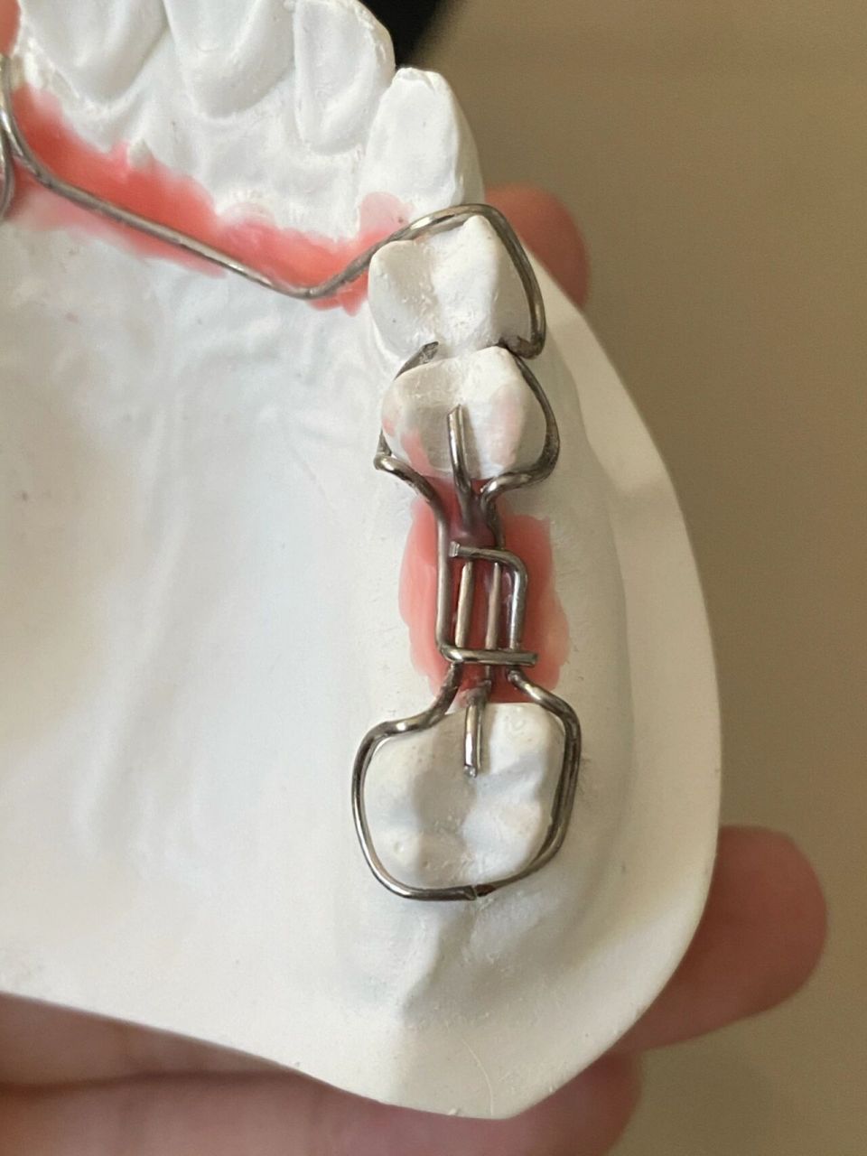 口腔医学日常|三臂卡环弯制