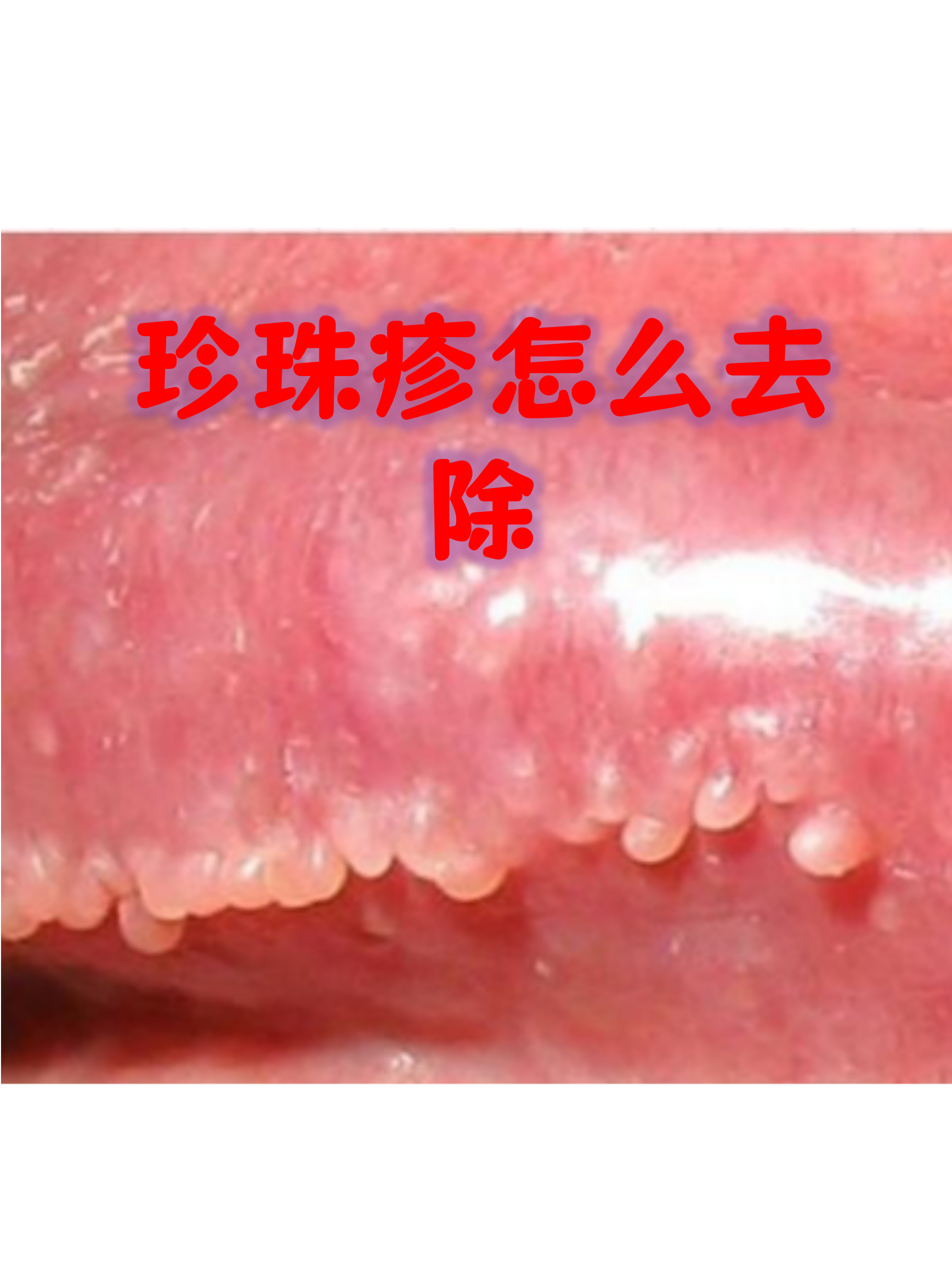 珍珠疹是男性会阴部常见的良性病变,看起来像一排排