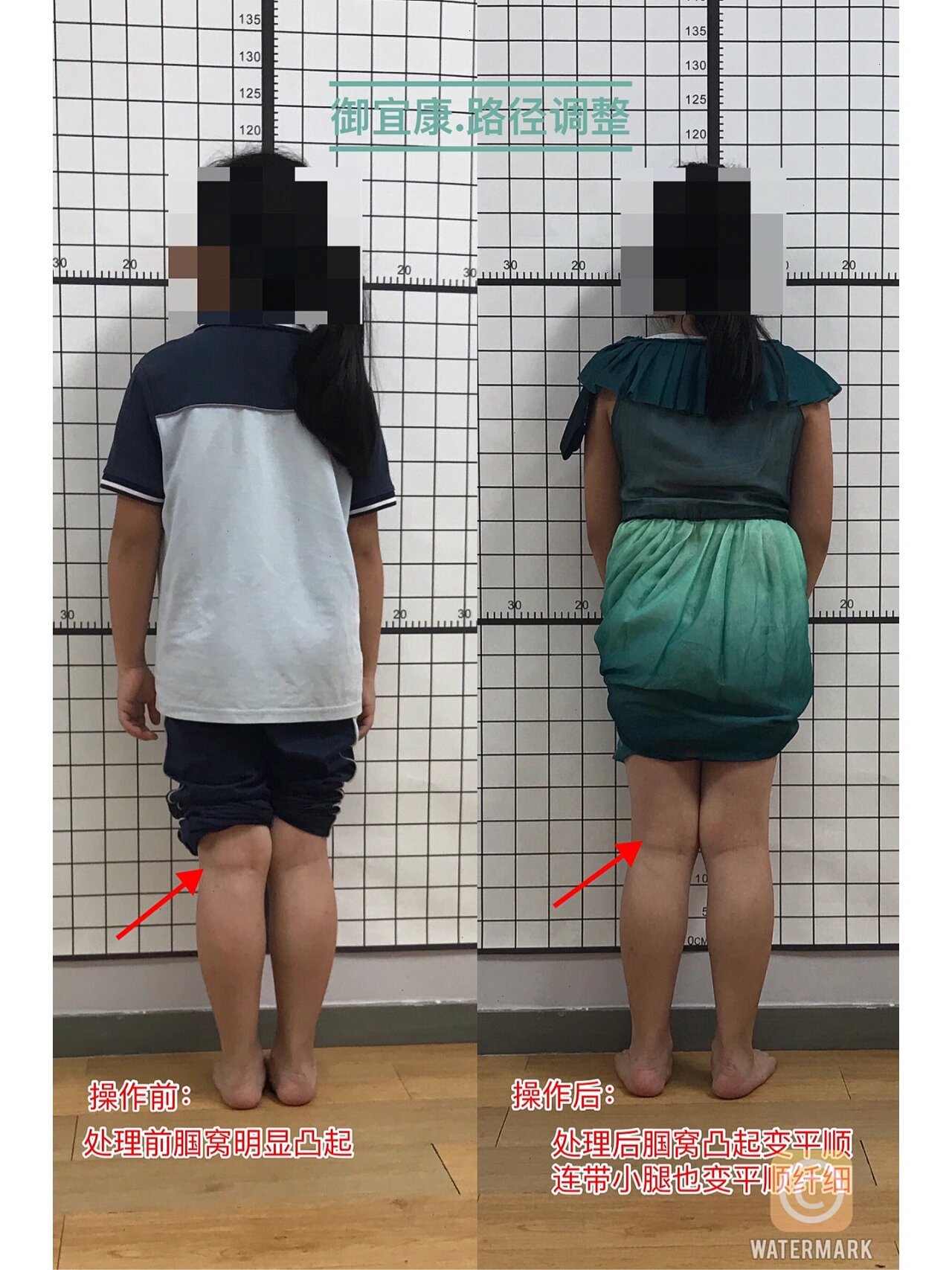 9岁小女孩 小腿后侧腘窝突起,操作2次改善