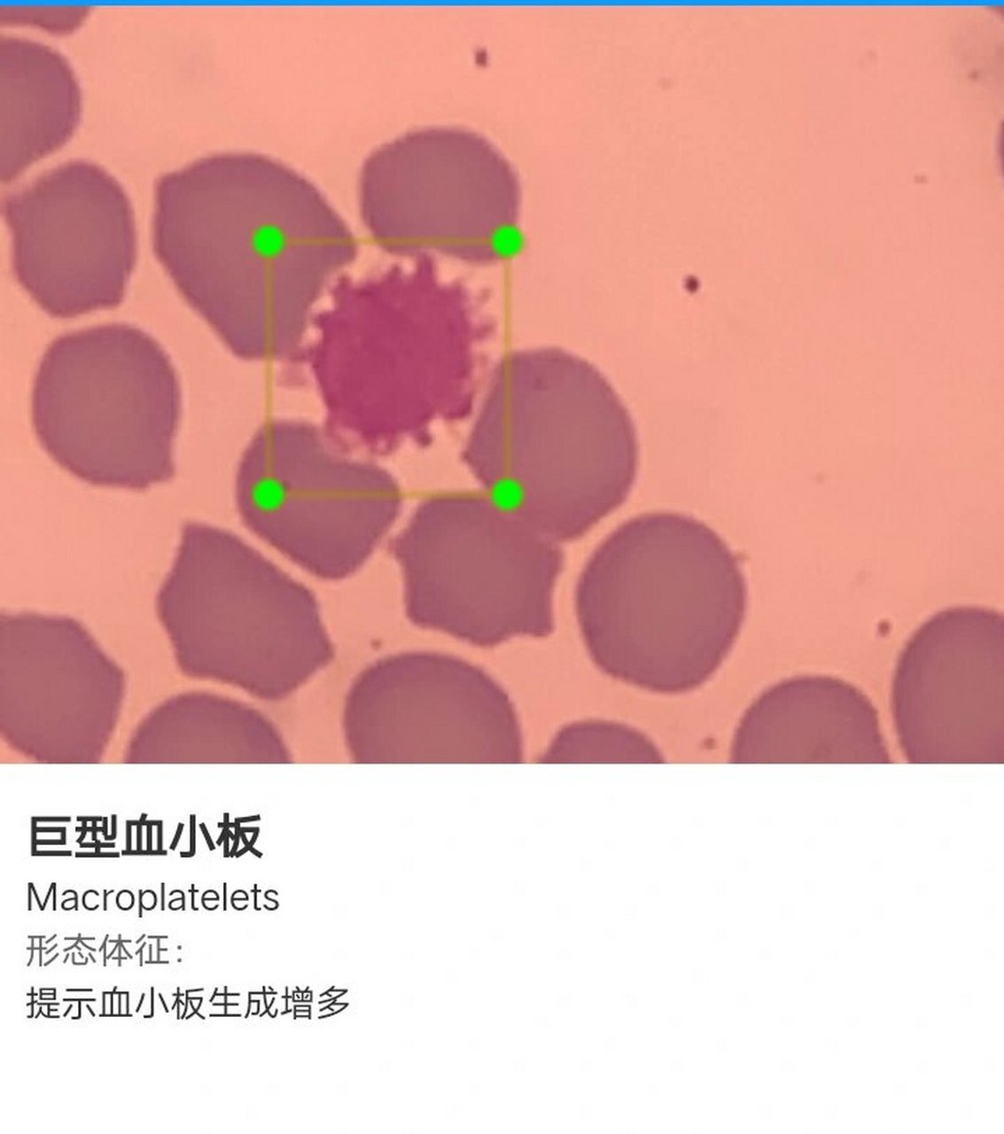 巨型血小板图片