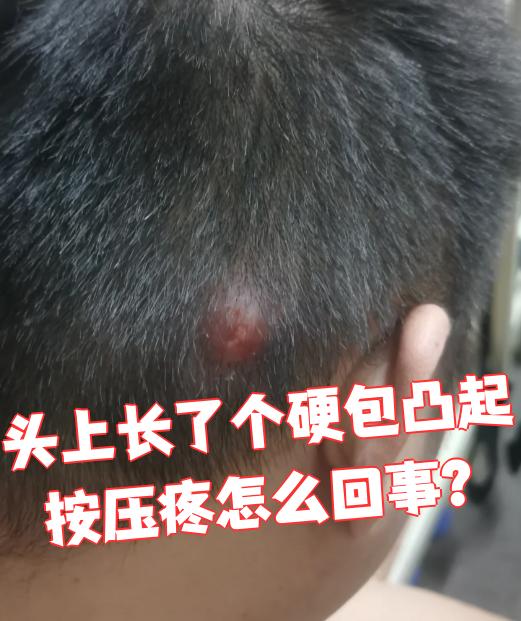 头上长了个硬包还一按就疼?