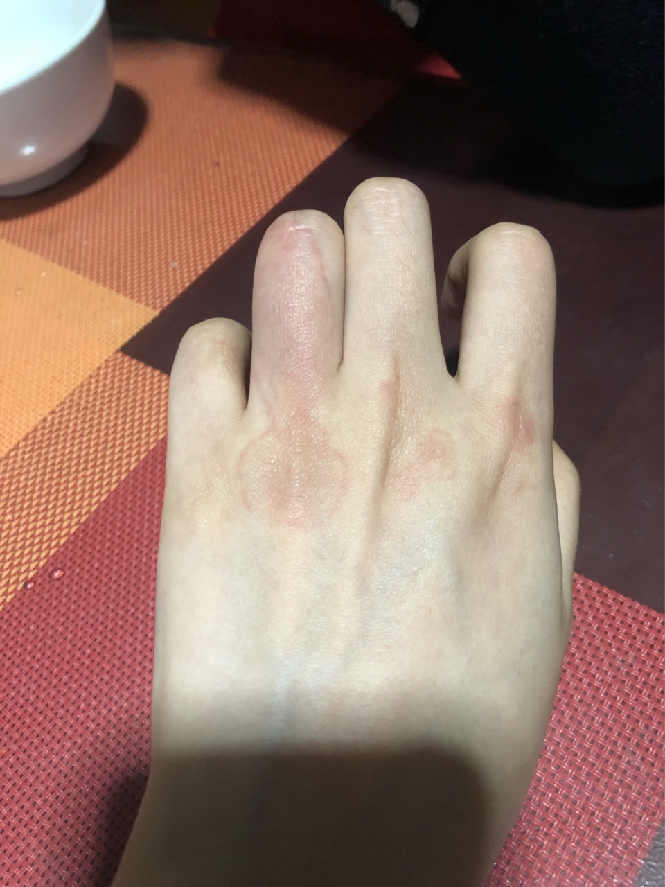 怎么拯救你环形红斑!