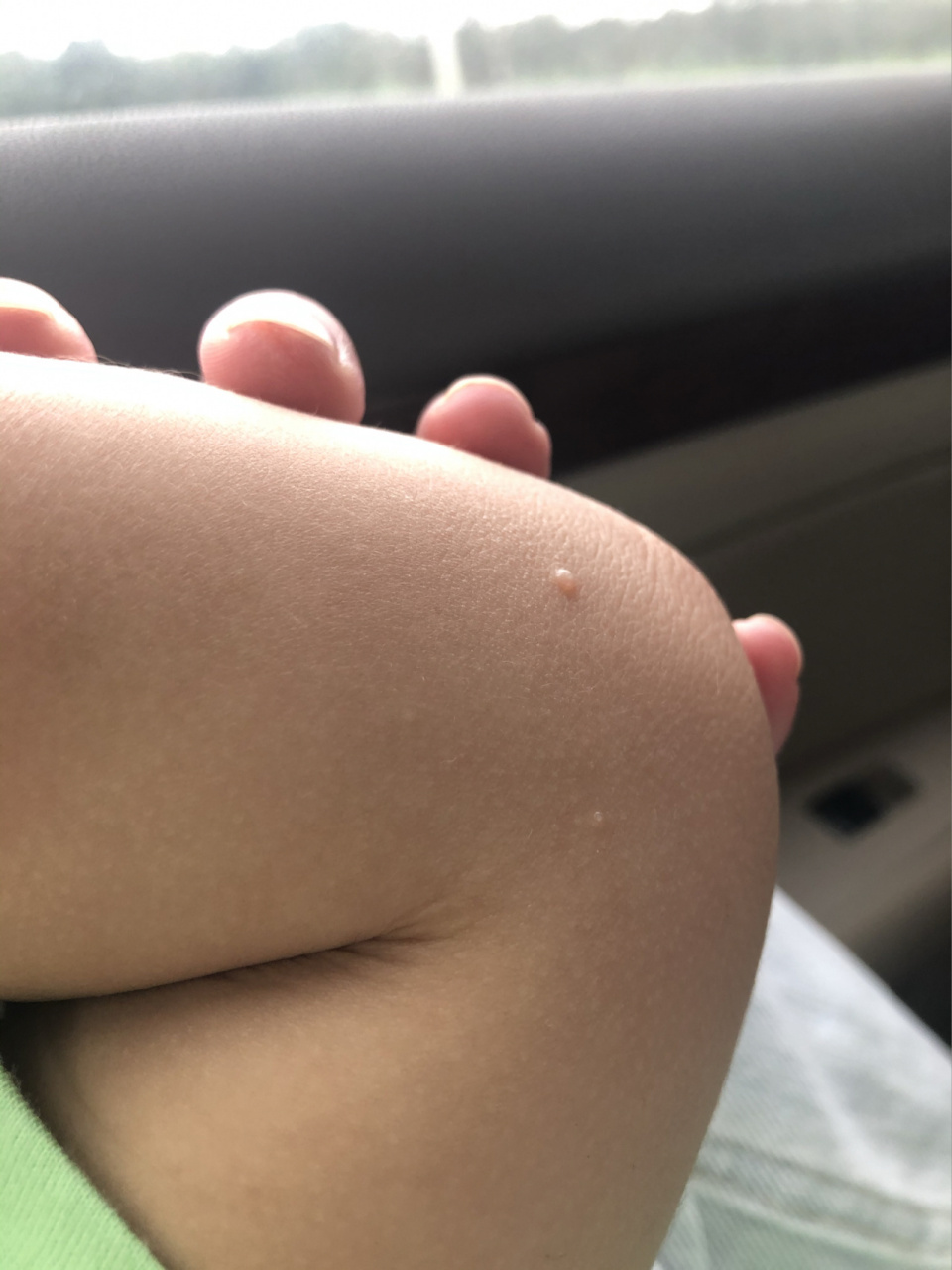 我家孩子身上怎么长了这么多"疣".