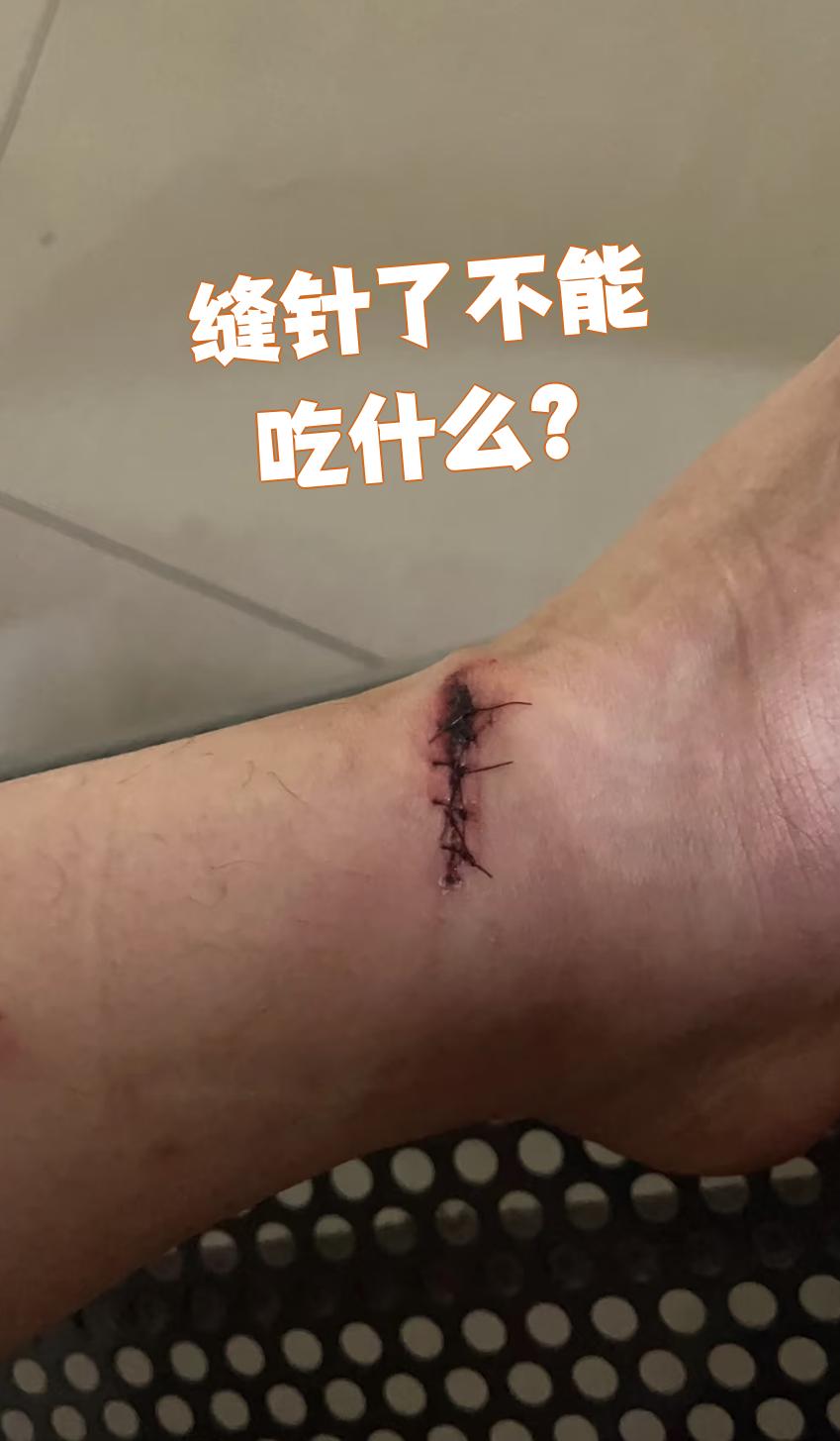 缝针后要注意饮食,有些东西不能吃: