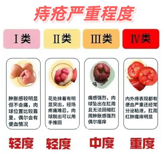环形痔其实是内痔和混合痔发展到最严重的阶段,痔疮在肛门口围成一