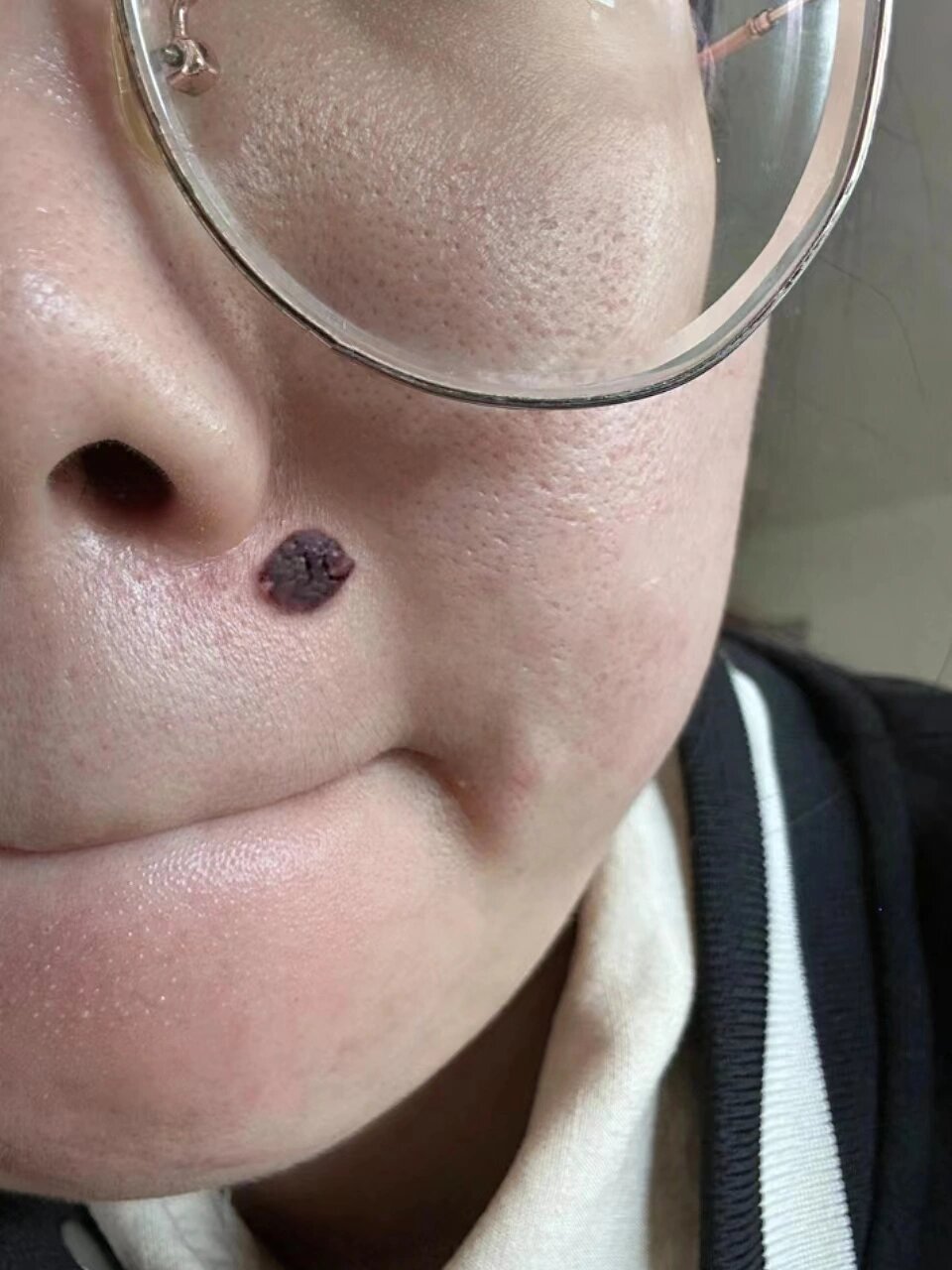 先说说我的情况:我妈说我脸上这颗痣刚生下来就有,那时候跟圆珠笔点