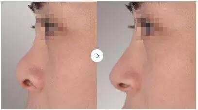 马鞍鼻的三种类型 轻度图二:鼻骨轻度塌陷,鼻背稍扁平而宽,微凹陷或