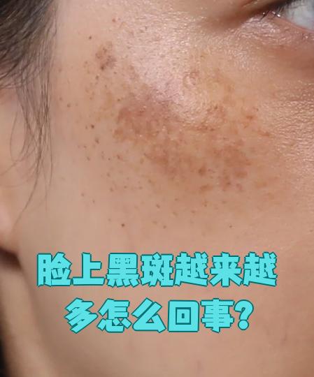 紫外线刺激皮肤产生更多黑色素,导致色斑加深