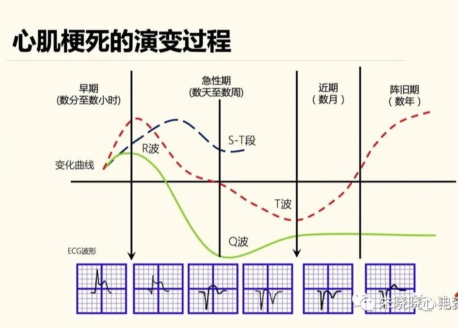 心绞痛心电图变化图片