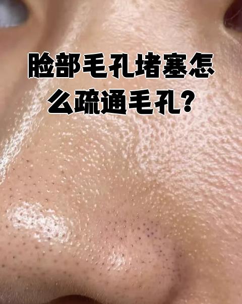 脸上毛孔堵了别着急,用果酸换肤就能解决