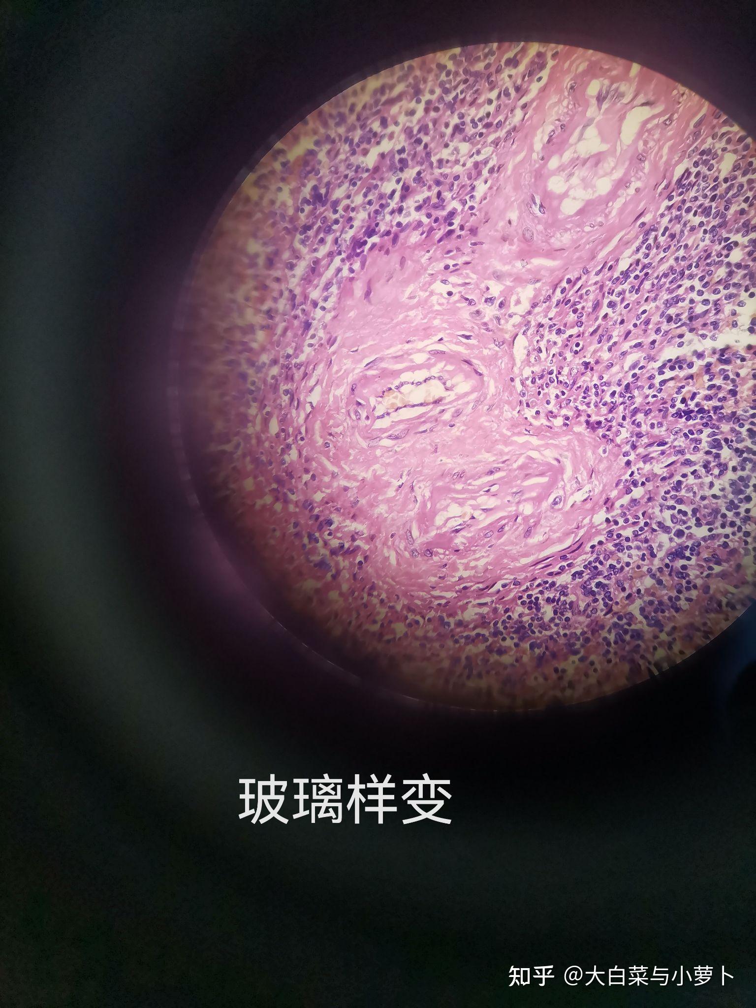病理实验玻片及诊断依据
