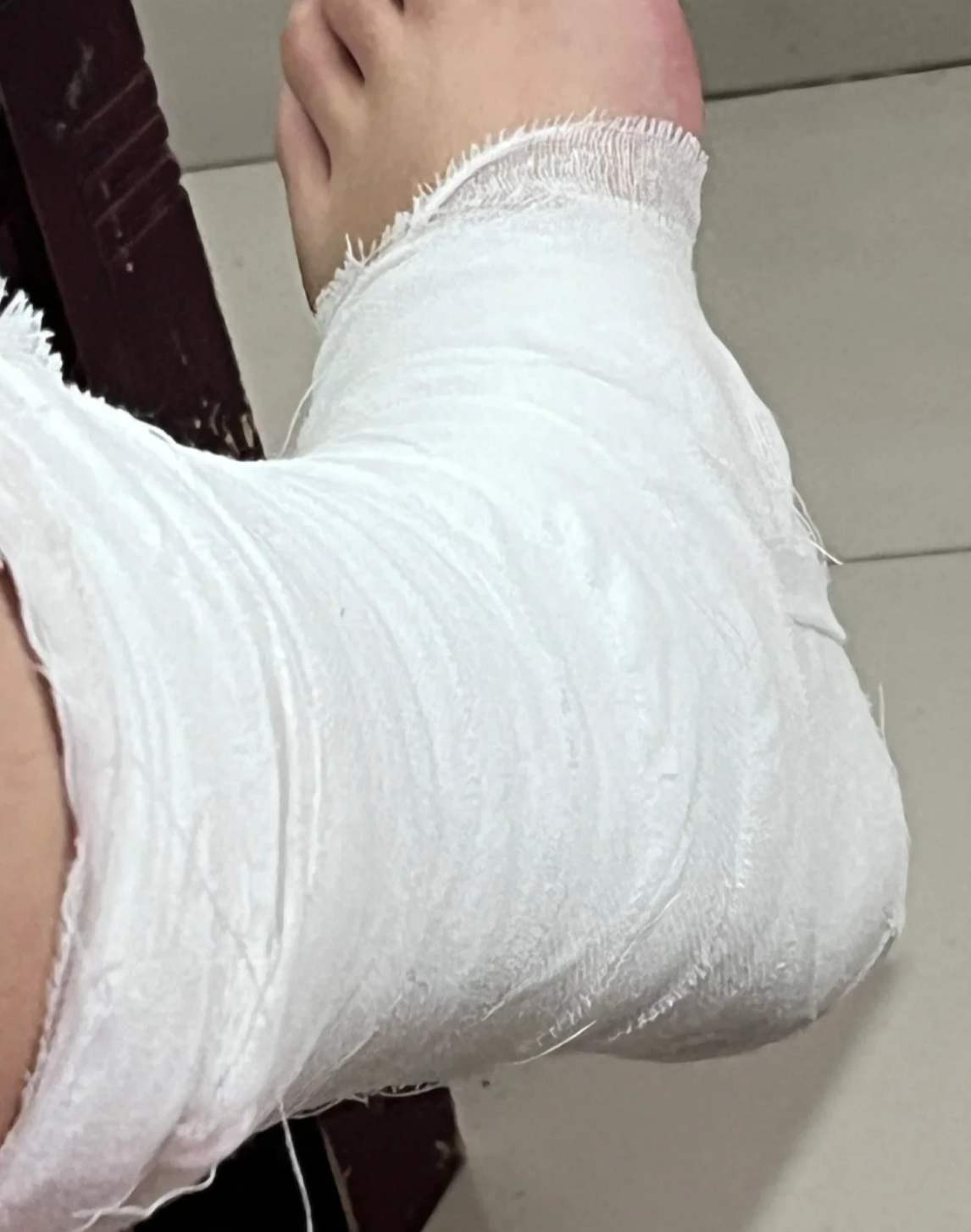 脚腕扭伤后要立刻处理,这样能好得快