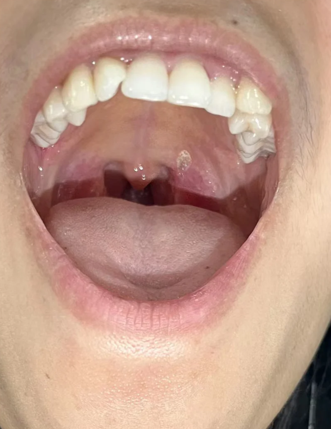 口腔上颚出现白色米粒状凸起,常见原因包括口腔溃疡