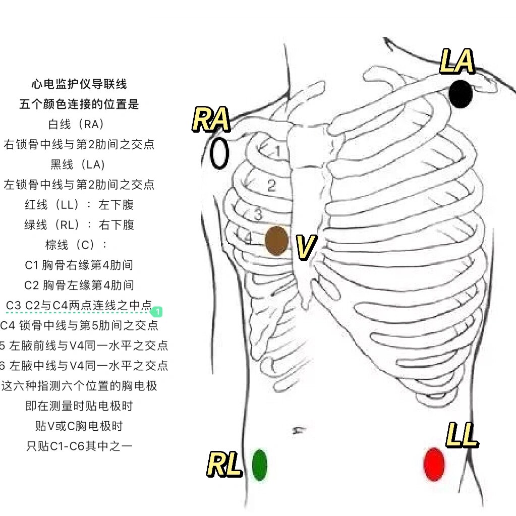 监护五导联位置图片图片