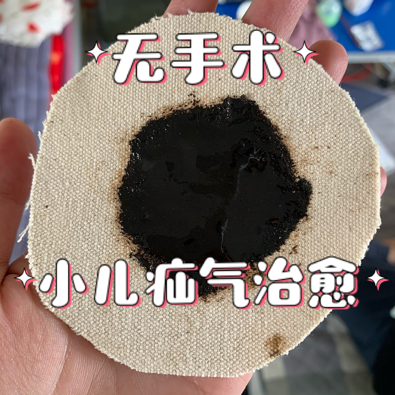 一个半月宝宝小儿疝气治愈 4月18日中午,换尿不湿时发现儿子腹股沟