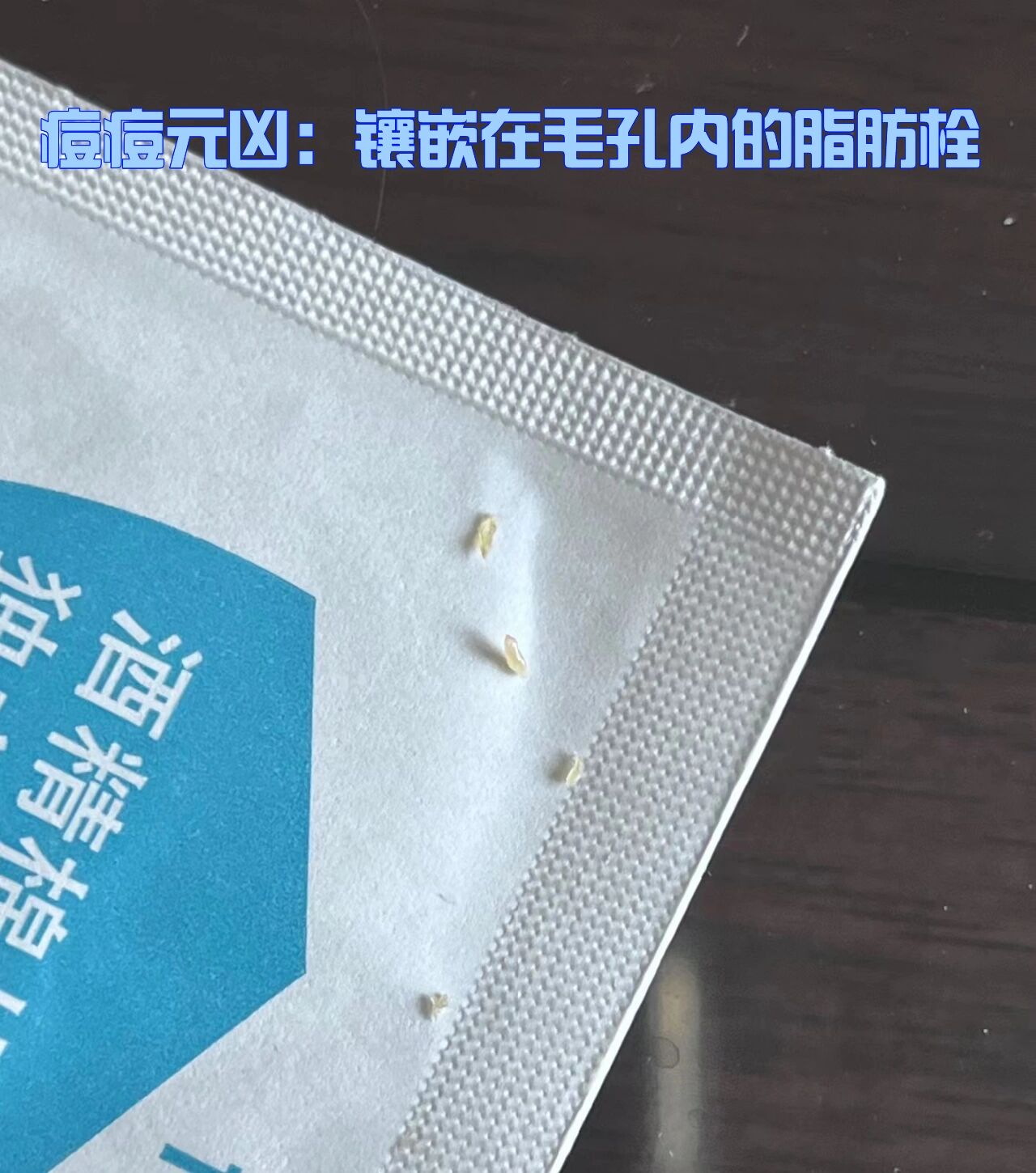 痘痘元凶:镶嵌在毛孔内的脂肪栓 咱就是说,这痘痘就是堵塞,堵塞就是