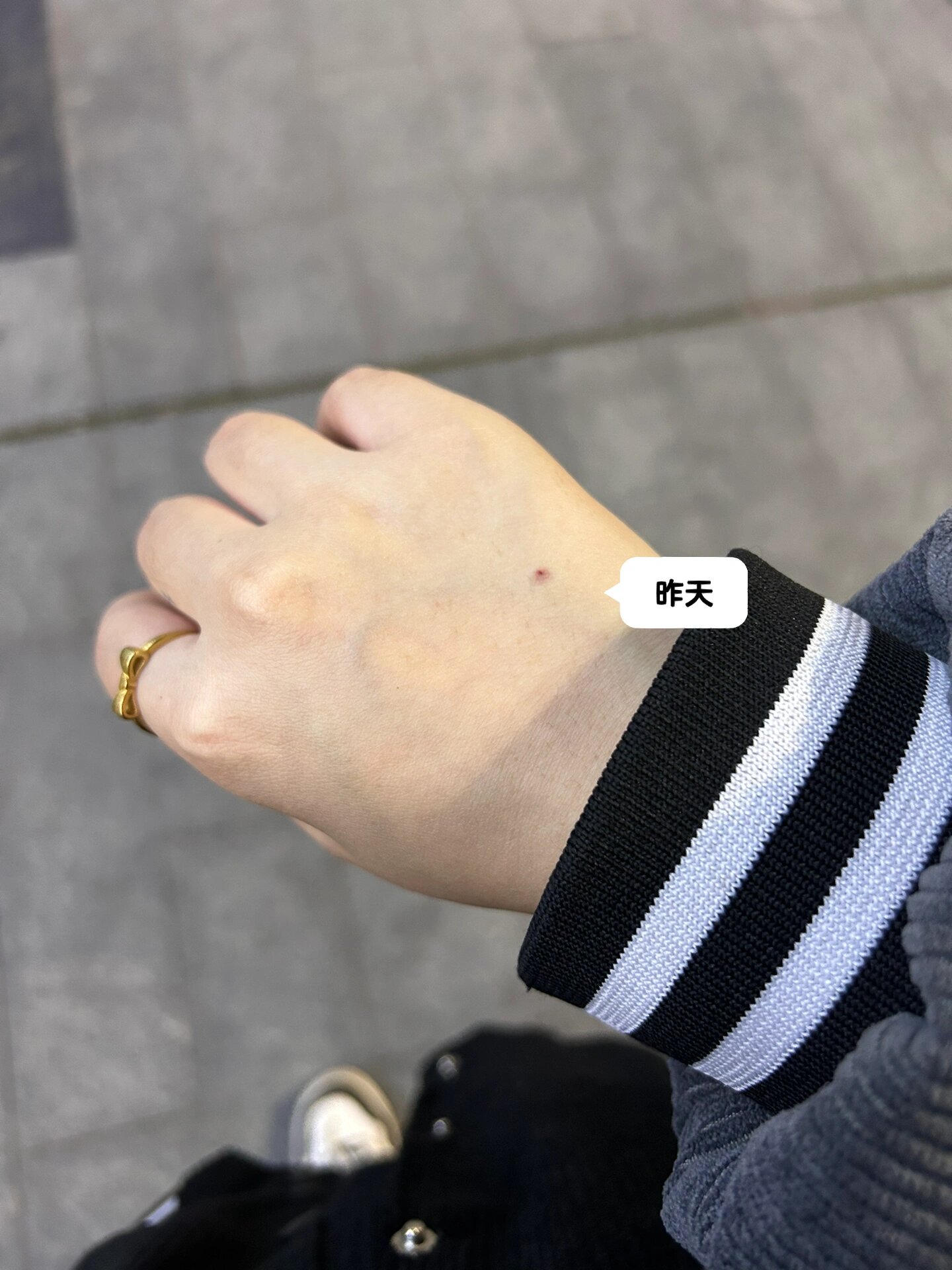 输完液手背淤血 昨天输完液 今天针眼这里好大一块淤血 越来越大了