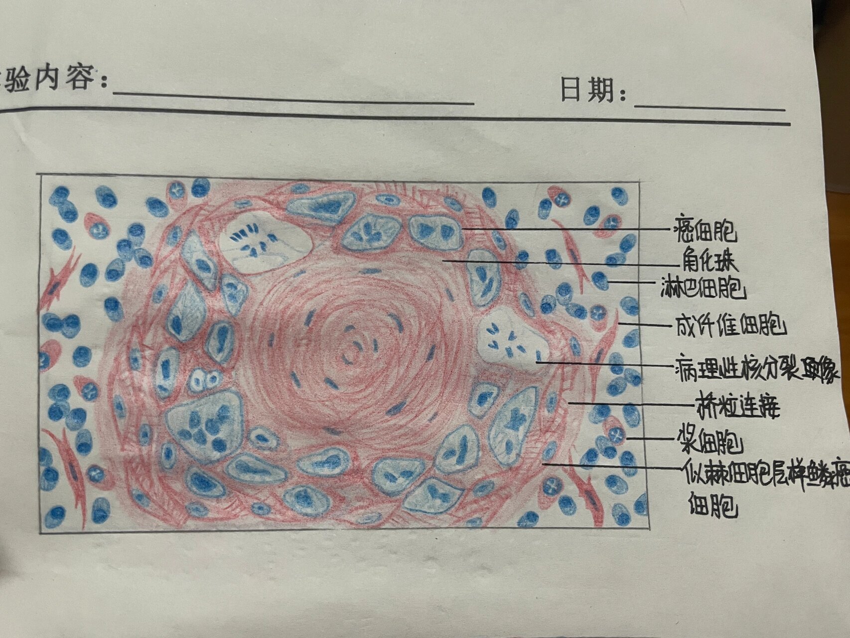 小细胞癌红蓝铅笔图图片