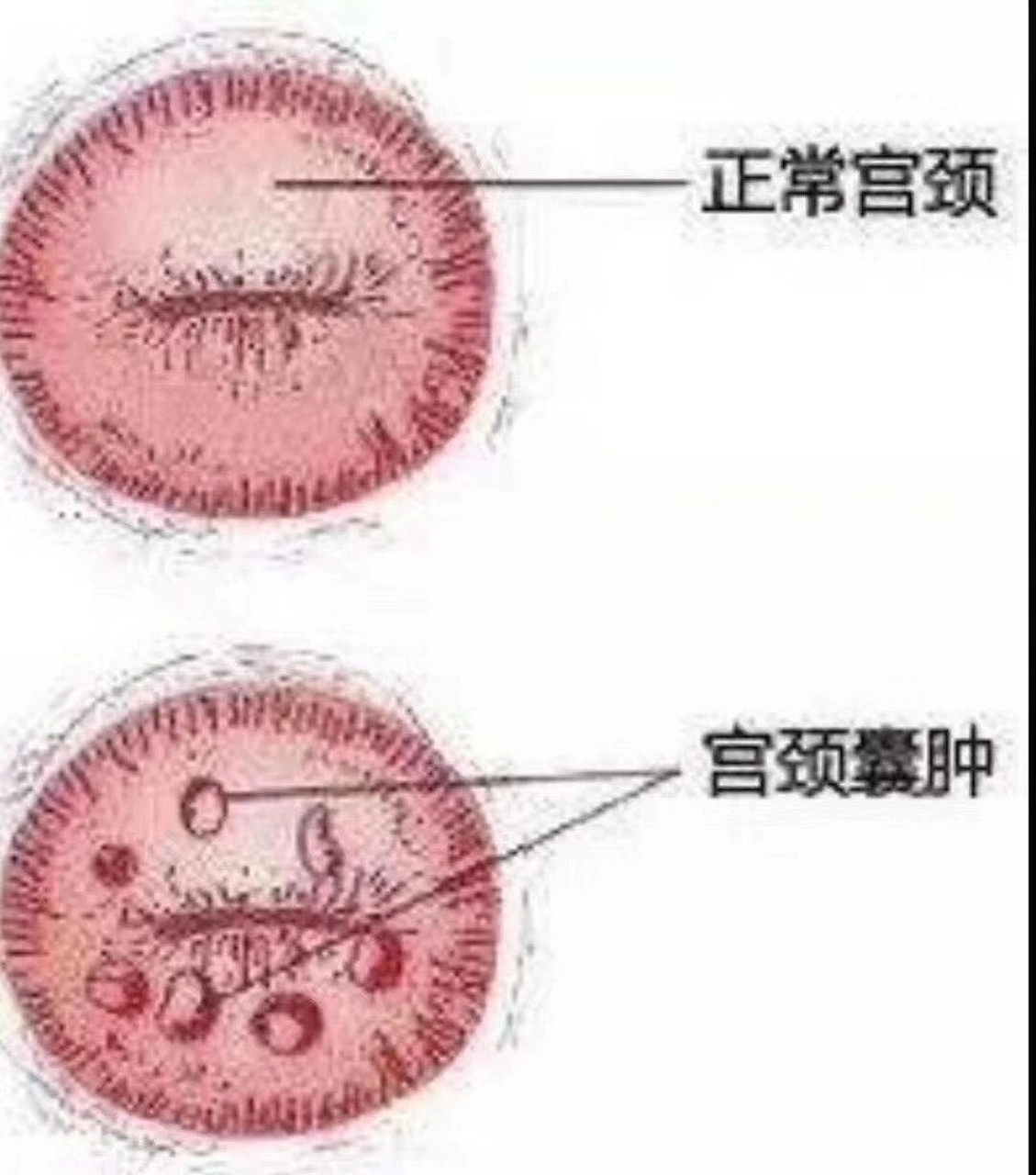 纳氏囊肿是怎么回事图片