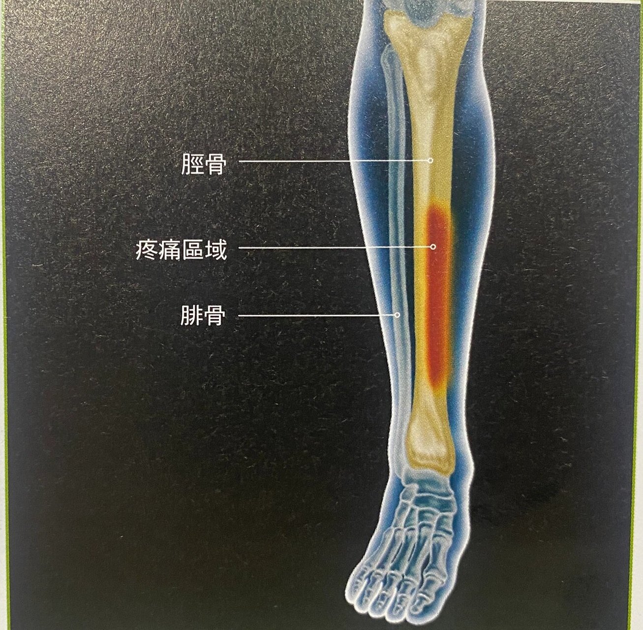 跑步腓骨疼图片