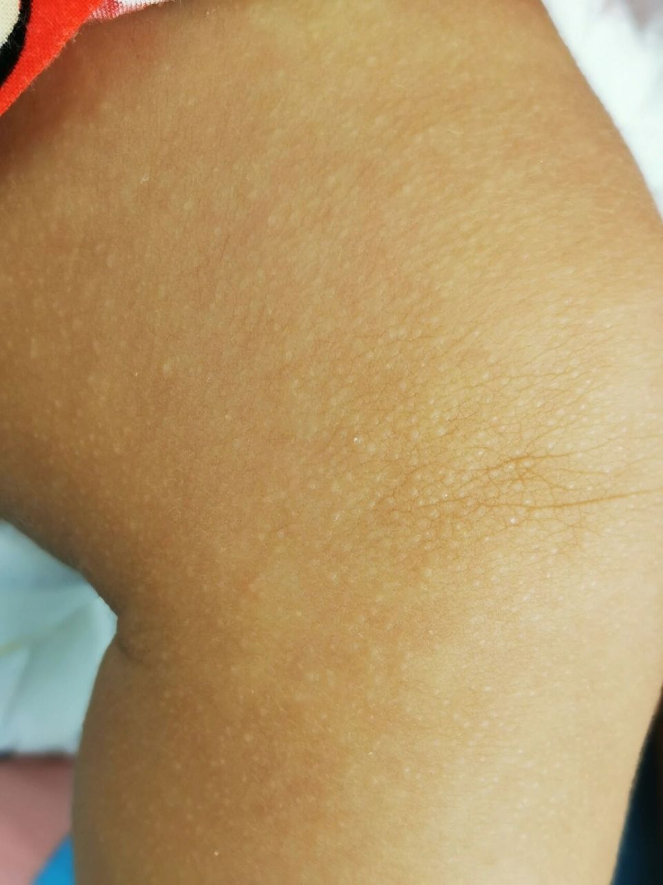 有没有宝宝身上起这种鸡皮疙瘩的 大数据麻烦帮忙推一下,实在是没办法