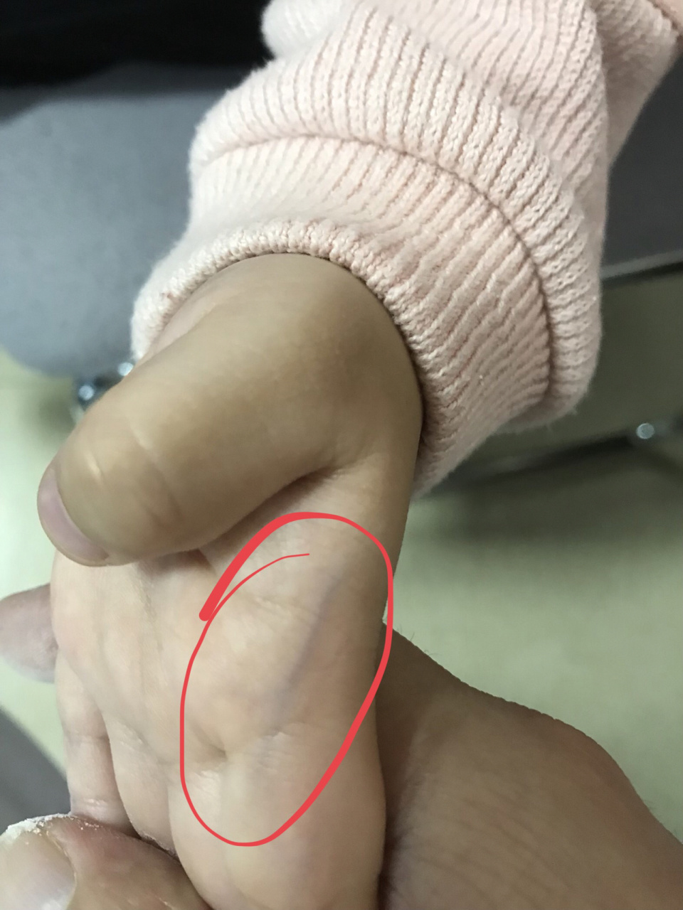 小儿指纹色紫红,家长要当心 小儿指纹的变化可以反映儿童的虚实寒热.