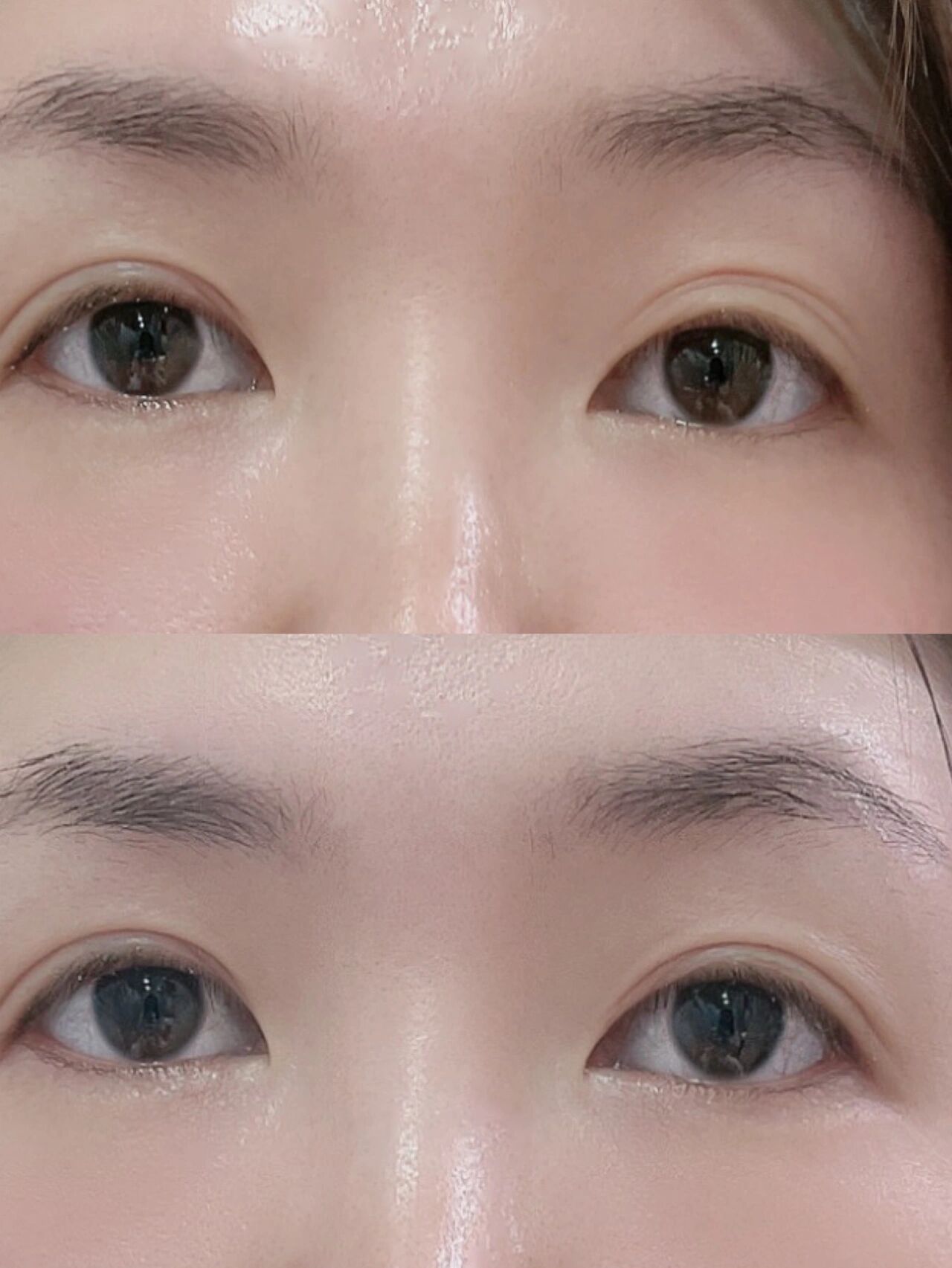 三眼皮变回双眼皮 前段一觉醒来,双眼皮就成三眼皮了 而且4天了都没变