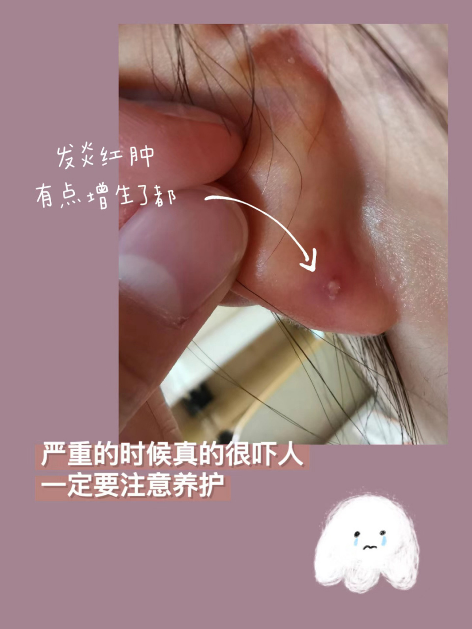 耳洞发炎了咋办?