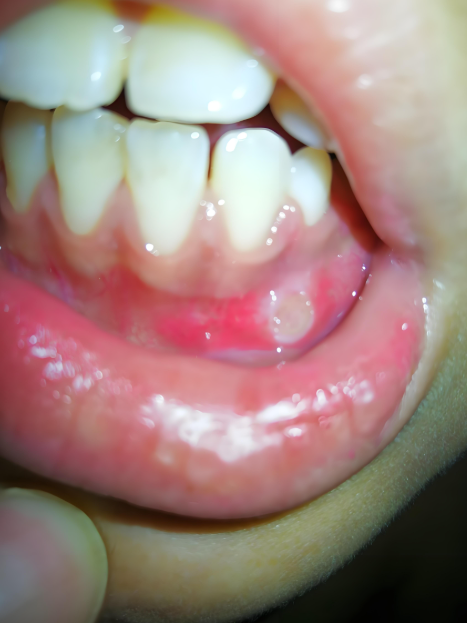 这个药闻起来有香味,味道辛凉,专门对付热毒引起的咽喉肿痛,牙龈肿痛