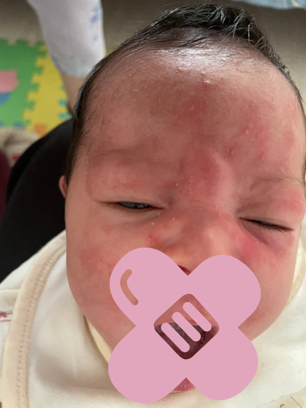 宝宝脸上红点,区别新生儿痤疮和湿疹 新生儿痤疮见图1～3,在宝宝出生