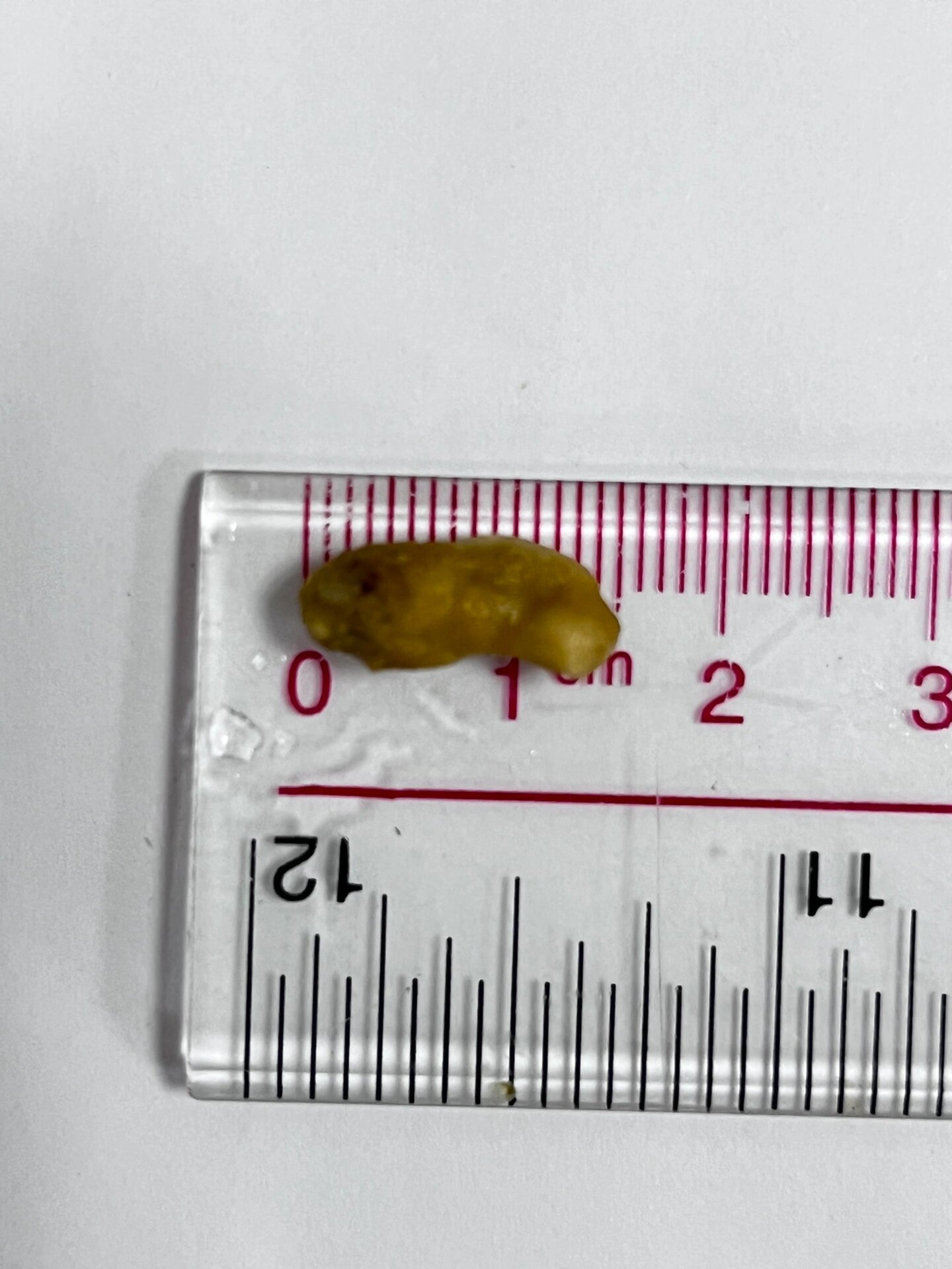 二十几年结石患者排出15*7mm结石