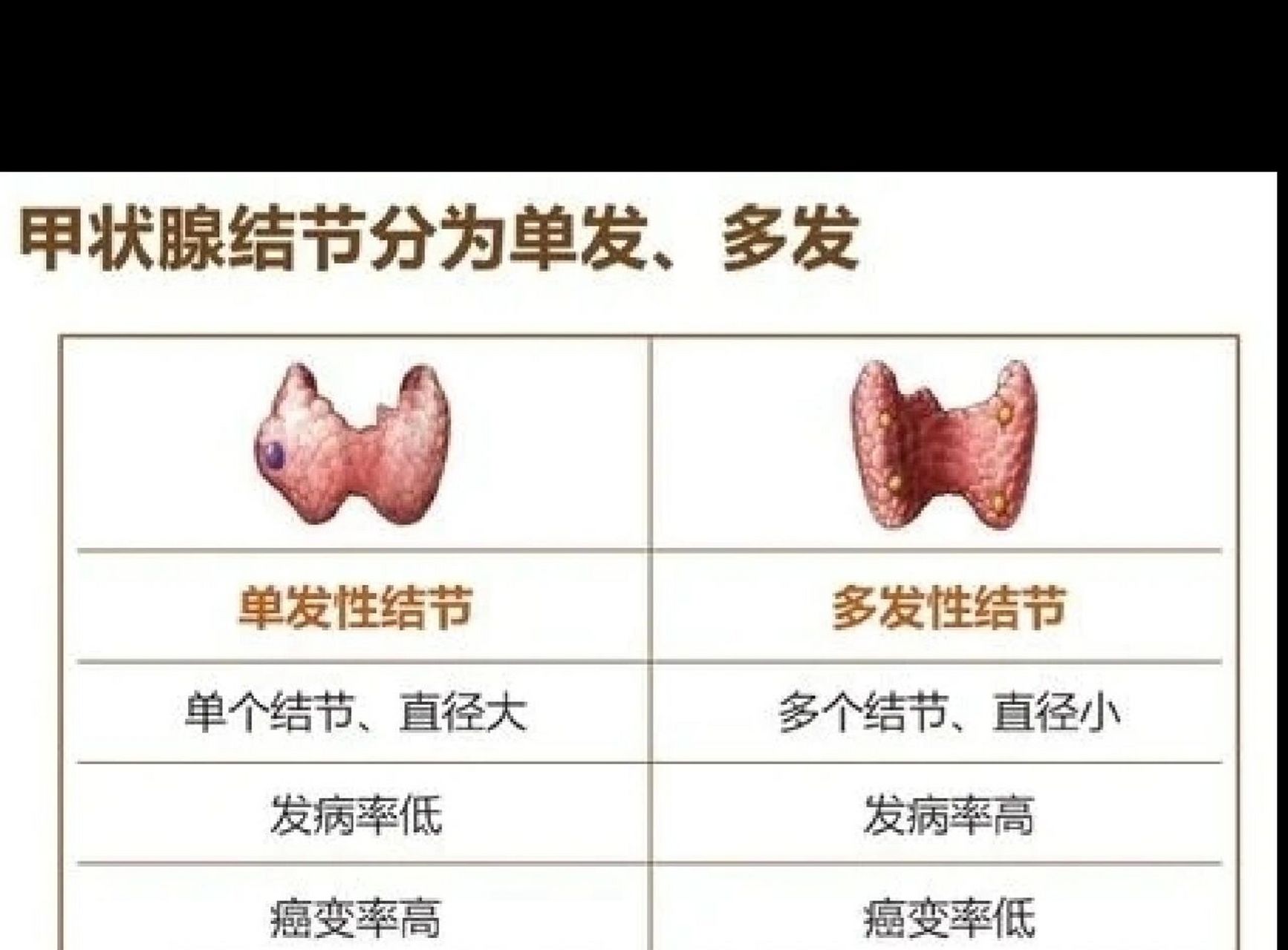 甲状腺结节自查图恶性图片