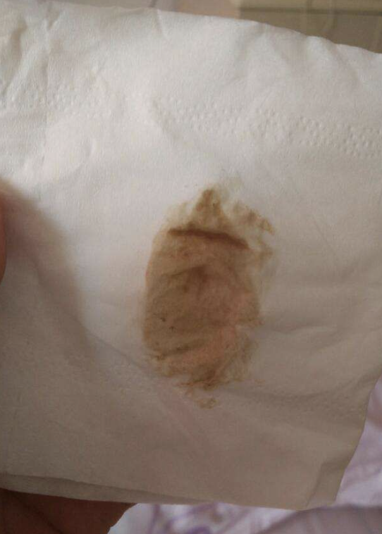 吃了紧急避孕药两周后出现褐色分泌物,这种情况需要结合具体原因