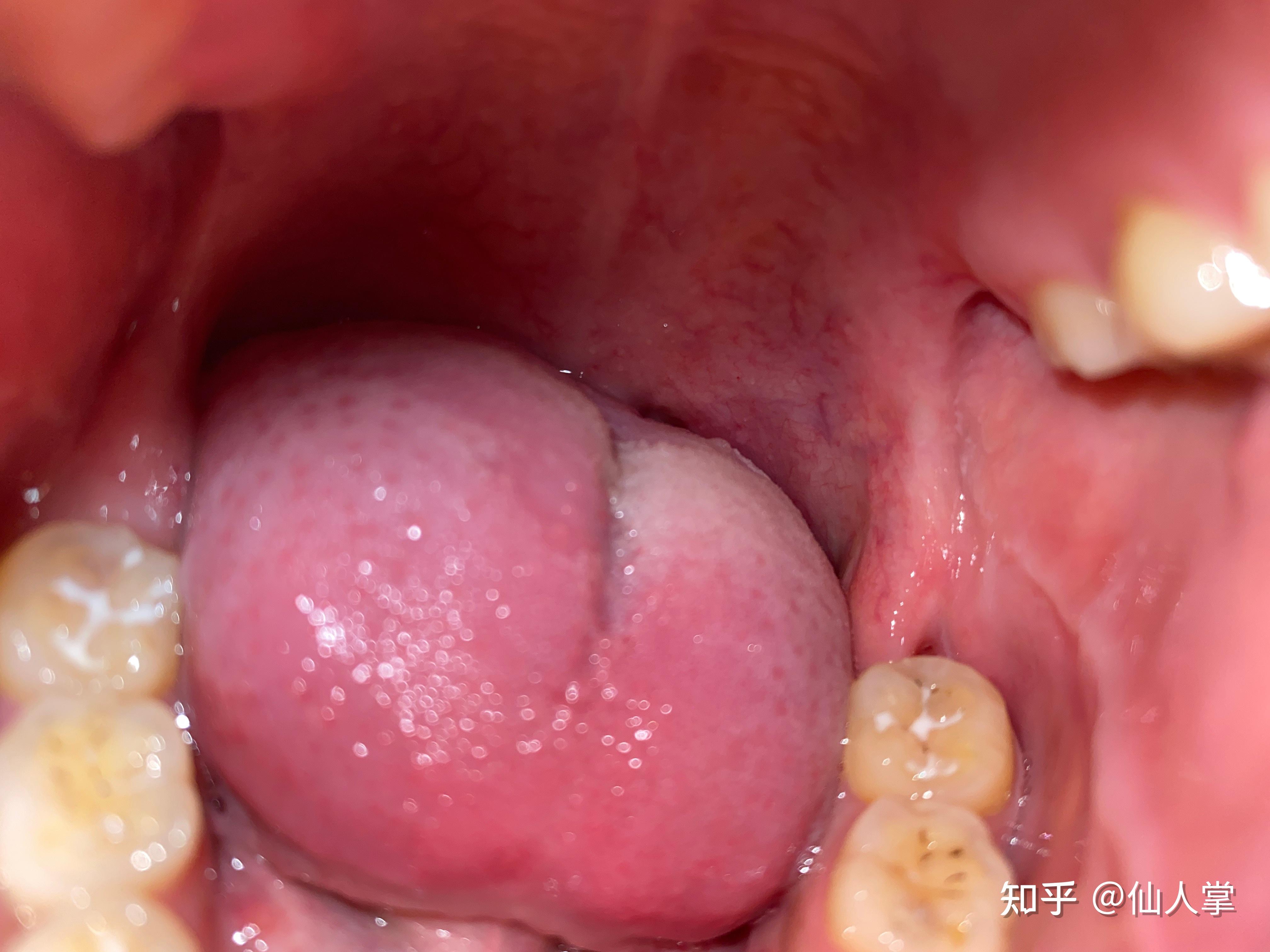 口腔内壁长了一个泡子想问一下有没有大佬知道是什么