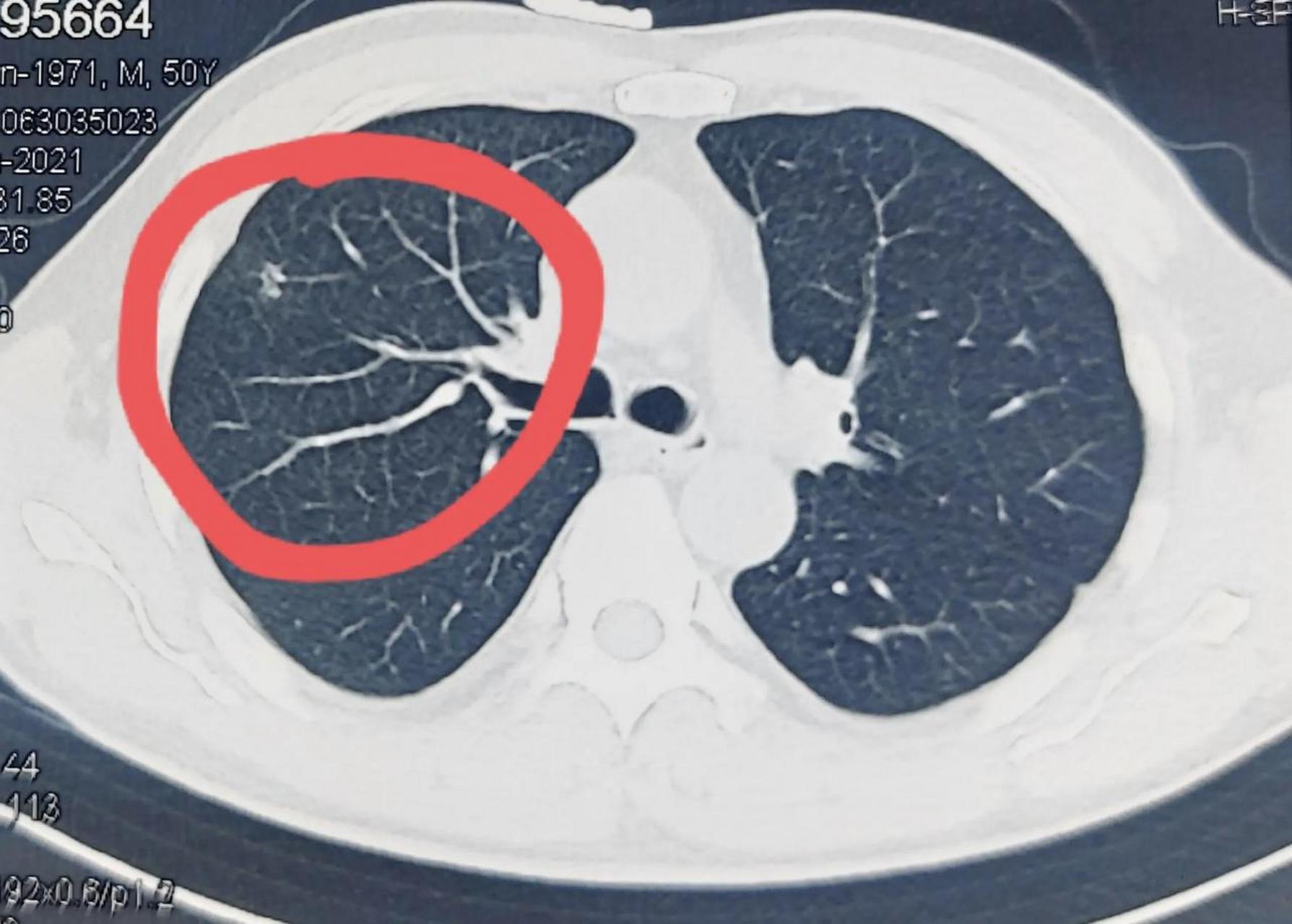 肺结节是指直径小于3cm的肺部影像学表现为圆形或椭圆形的病灶.