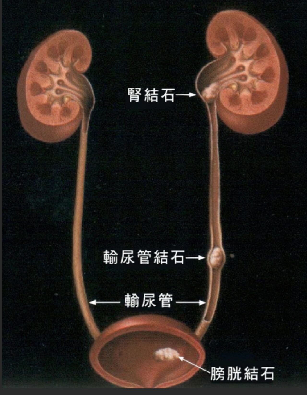 尿结石在什么位置图片图片