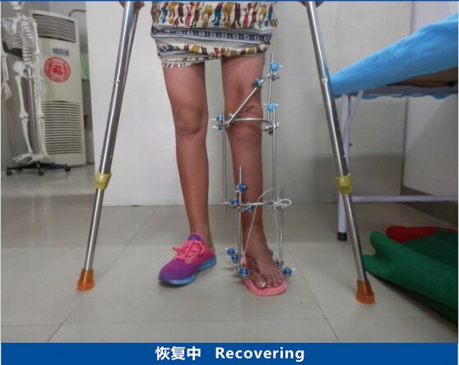 小儿麻痹后遗症 患者:女,34岁,儿麻后遗症.