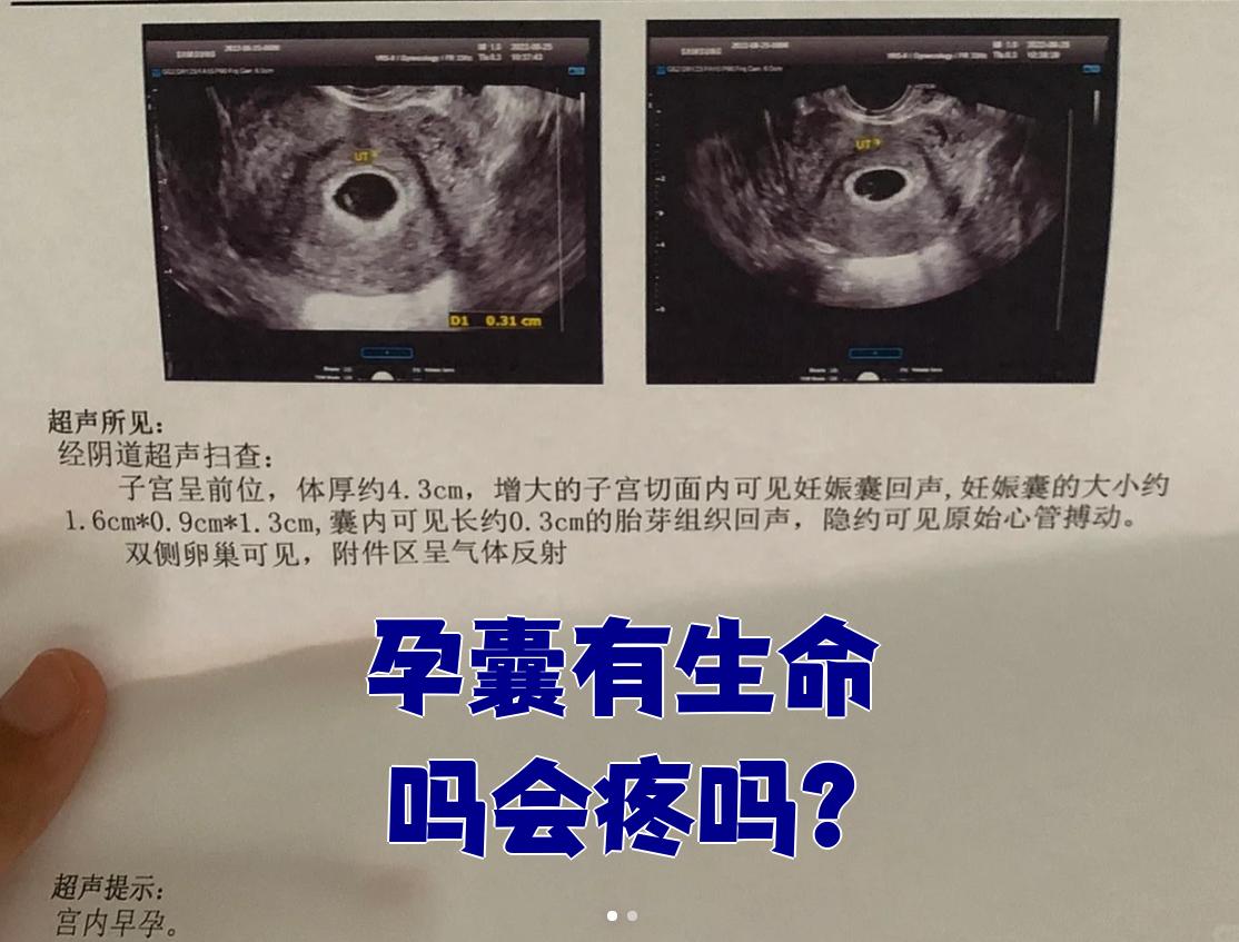 孕囊是胚胎的早期形态,由精子和卵子结合形成受精卵后,在子宫内撞床